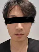 医療脱毛（顔） ミラクリニック 池袋院 BEFORE サムネイル用