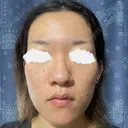 ダーマペン 共立美容外科 横浜院 BEFORE サムネイル用