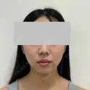 糸リフト / 脂肪吸引（顔） / ジョールファット除去 / ヒアルロン酸注入（あご） SEA CLINIC（シークリニック） BEFORE サムネイル用