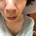 その他（鼻） / アグネス フェアクリニック川口 BEFORE サムネイル用