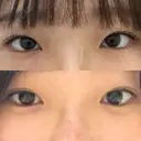 目頭切開 くさのたろうクリニック BEFORE サムネイル用