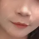 人中短縮 / 目尻切開 / タレ目形成・グラマラスライン（切開） / ボトックス（人中） / その他（鼻） ルラ美容クリニック 大阪本院 BEFORE サムネイル用