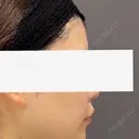 脂肪注入（額） / ヒアルロン酸溶解 ルーチェクリニック 銀座院 BEFORE サムネイル用
