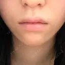 ボトックス（あご） / 肌ヒアルロン酸注入（たるみ・シワ改善） / ヒアルロン酸注入（唇） / ヒアルロン酸注入（鼻翼基部） 札幌TAクリニック BEFORE サムネイル用