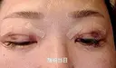 目元修正 / 自然癒着法 LUHO（ルホ）美容外科 BEFORE サムネイル用