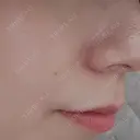 ボトックス（エラ・小顔） / その他（口元） 共立美容外科 福岡院 BEFORE サムネイル用