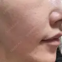 ピーリング（ニキビ・毛穴） Re:anne clinic 銀座 【リアンクリニック銀座】 BEFORE サムネイル用