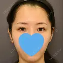 目頭切開 / 脂肪吸引（顔） / 目尻切開 / 脂肪注入（肌） / 脂肪注入（額） / 口角挙上 / メーラーファット除去 / タレ目形成・グラマラスライン（埋没） / 脂肪注入（輪郭） 札幌ル・トロワ ビューティクリニックVogue BEFORE サムネイル用