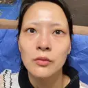 クマ治療 池袋麗歯科・美容皮膚科 BEFORE サムネイル用