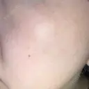 光治療（フォトフェイシャルなど） 共立美容外科 仙台院 BEFORE サムネイル用