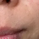 肌ヒアルロン酸注入（たるみ・シワ改善） TCB東京中央美容外科 姫路院 BEFORE サムネイル用