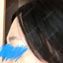 ヒアルロン酸注入（額） ヴェリテクリニック 大阪院 BEFORE サムネイル用