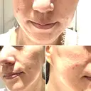 ポテンツァ 聖心美容クリニック 福岡院 BEFORE サムネイル用
