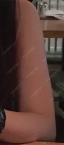 脂肪冷却（二の腕） LE CLINIC BEFORE サムネイル用