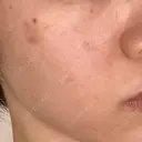 白玉点滴・注射 / シミ取りレーザー S-Laboクリニック 渋谷院 BEFORE サムネイル用