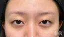 二重埋没 湘南美容クリニック 博多院 BEFORE サムネイル用