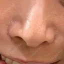 その他（肌） 代官山ウィメンズクリニック BEFORE サムネイル用