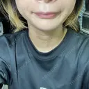 脂肪溶解注射（顔） TCB東京中央美容外科 横浜院 BEFORE サムネイル用