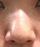隆鼻術 / 鼻尖形成（切開） / 鼻中隔延長（切開） / 小鼻縮小（切開） / 骨切幅寄せ / ワシ鼻修正・ハンプ切除 / 鼻尖縮小 FROM B整形外科 (旧バウム整形外科) BEFORE サムネイル用