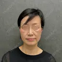 糸リフト / クマ治療 / ヒアルロン酸注入（目の下） ネビュラクリニック 京都院 BEFORE サムネイル用