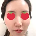 ヒアルロン酸注入（鼻） / ヒアルロン酸注入（唇） / ヒアルロン酸注入（頬） / ヒアルロン酸注入（こめかみ） BIANCA銀座 BEFORE サムネイル用
