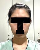 糸リフト / バッカルファット除去 / 脂肪吸引（顔） / 脂肪注入（額） / ボトックス（あご） / 脂肪注入（輪郭） セギム美容整形外科 BEFORE サムネイル用