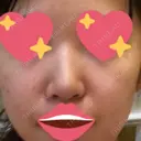 隆鼻術 / 鼻尖形成（切開） / 軟骨移植 / 骨切幅寄せ / ワシ鼻修正・ハンプ切除 / 斜鼻修正 / 鼻修正 韓国BBクリニック（旧 シンミアン形成外科） BEFORE サムネイル用