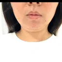 脂肪溶解注射（顔） / ハイフ（顔） AZ BEAUTY CLINIC BEFORE サムネイル用