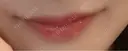 ヒアルロン酸注入（唇） / ボトックス（口角） KAGA CLINIC BEFORE サムネイル用