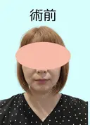 糸リフト / 脂肪吸引（顔） / メーラーファット除去 / ジョールファット除去 / 脂肪吸引注射（顔） ziz CLINIC BEFORE サムネイル用