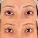 眼瞼下垂（非切開） SOL CLINIC BEFORE サムネイル用
