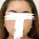 ピーリング（ハリ・ツヤ） 渋谷美容外科クリニック 横浜院 BEFORE サムネイル用