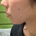 ボトックス（あご） / ヒアルロン酸注入（あご） BIZENNクリニック【ビゼンクリニック】 BEFORE サムネイル用