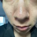 アグネス / その他（鼻） フェアクリニック川口 BEFORE サムネイル用