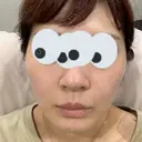 美容点滴・美容注射（ダイエット） / 美容点滴・美容注射（疲労回復） / ピコレーザートーニング（美白・肝斑） / ピーリング（ハリ・ツヤ） / ピコフラクショナルレーザー（毛穴・ニキビ跡） 表参道メディカルクリニック 大阪院 BEFORE サムネイル用