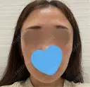 イオン導入 / ピコレーザートーニング（美白・肝斑） ルラ美容クリニック 渋谷本院 BEFORE サムネイル用