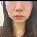 ボトックス（エラ・小顔） TCB東京中央美容外科 福岡博多院 BEFORE サムネイル用