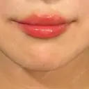 ヒアルロン酸注入（涙袋） / ヒアルロン酸注入（唇） 東京シンデレラ美容外科 大宮院 BEFORE サムネイル用