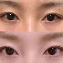 二重切開 / 眼瞼下垂（切開） / 上まぶたたるみ取り 湘南美容クリニック 新宿南口院 BEFORE サムネイル用