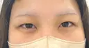 二重埋没 / ヒアルロン酸注入（涙袋） BELINDA CLINIC（ベリンダクリニック）新宿院 BEFORE サムネイル用