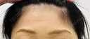 ボトックス（額） TCB東京中央美容外科 青森院 BEFORE サムネイル用