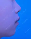 ヒアルロン酸注入（あご） ヴェリテクリニック 大阪院 BEFORE サムネイル用