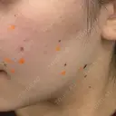 ほくろ・いぼ除去レーザー（肌） Jスキンクリニック 【J-SKIN clinic】 BEFORE サムネイル用