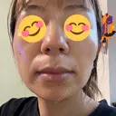 ピコレーザートーニング（美白・肝斑） / フラクショナルレーザー（毛穴・ニキビ跡） G MEDICAL ART クリニック 新宿院 BEFORE サムネイル用