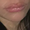 ボトックス（あご） / ヒアルロン酸注入（あご） 新宿TAクリニック BEFORE サムネイル用