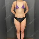 陥没乳頭形成 / 豊胸（シリコン＋脂肪併用） さくらビューティークリニック銀座 BEFORE サムネイル用