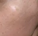 ルメッカ B-LINE CLINIC 池袋院 BEFORE サムネイル用