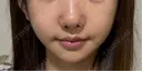 ボトックス（エラ・小顔） L‘amour clinic Tokyo【ラムールクリニック東京】 BEFORE サムネイル用