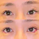 目尻切開 / タレ目形成・グラマラスライン（埋没） LOUIS CLINIC 二子玉川院【ルイクリニック】 BEFORE サムネイル用