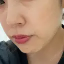 糸リフト / クマ治療 / 脂肪吸引（顔） / 下まぶたたるみ取り / 下まぶたの脂肪取り / 目元修正 / 脂肪吸引注射（顔） / その他（目元） Tokyo Tensei Clinic 新宿院 BEFORE サムネイル用